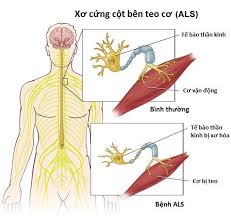 Bệnh xơ cột bên teo cơ một bên ALS