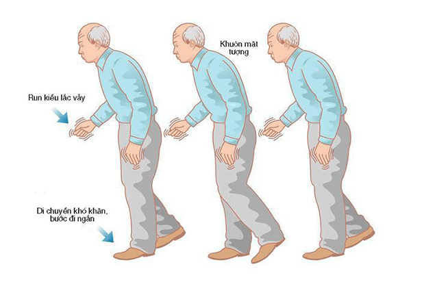 Bệnh Parkinson: Dấu hiệu nhận biết và cách điều trị