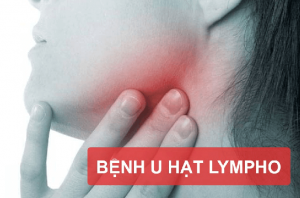 Bệnh U lympho cách điều trị và những điều cần biết