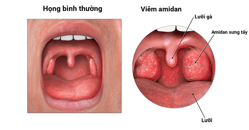 Bệnh viêm Amidan: Triệu chứng và những điều cần biết