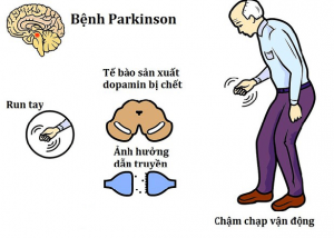 Biểu hiện của bệnh Parkinson