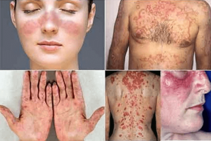 Các dạng Lupus ban đỏ