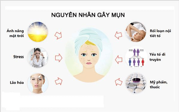 Mụn trứng cá: Nguyên nhân và cách điều trị