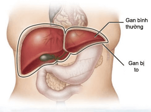 Gan to: Những điều cần biết và cách phòng ngừa