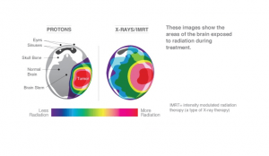  Hình ảnh So sánh hình ảnh lập kế hoạch điều trị cho bệnh nhân u não sử dụng liệu pháp proton và IMRT