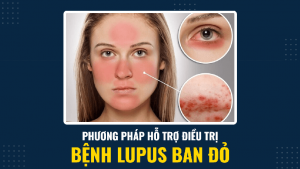 Phương pháp hỗ trỡ điều trị bệnh Lupus ban đỏ