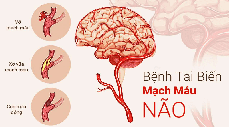 Tai biến mạch máu não: Những điều cần biết và cách phòng ngừa