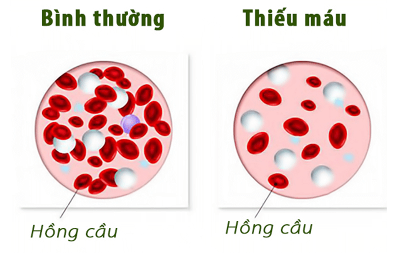 Thiếu máu: Dấu hiệu nhận nhiết và cách điều trị