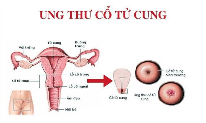 Ung thư cổ tử cung: Dấu hiệu và những điều bạn cần biết