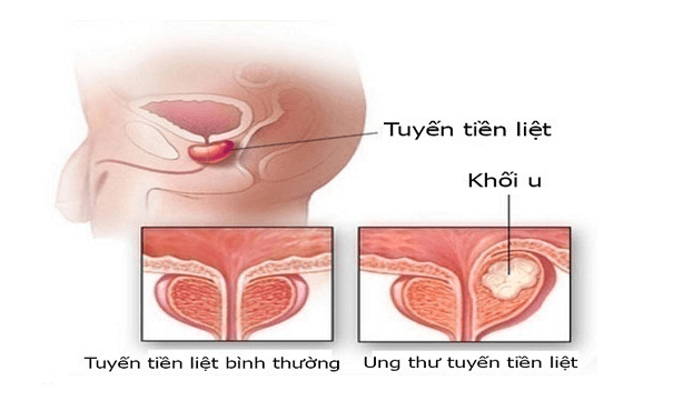 Ung thư tiền liệt tuyến: Triệu chứng và các phương pháp điều trị