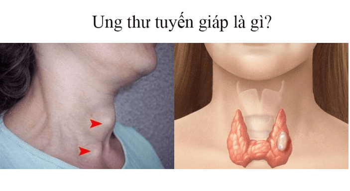 Ung thư tuyến giáp: Dấu hiệu và những điều bạn cần biết