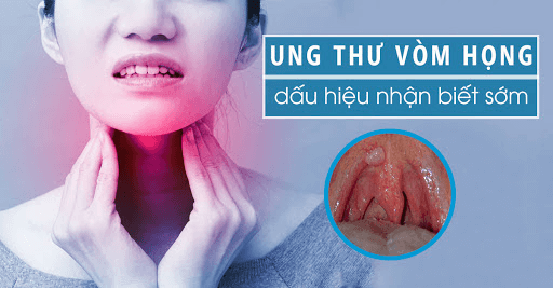 Ung thư vòm họng: Dấu hiệu và những điều bạn cần biết