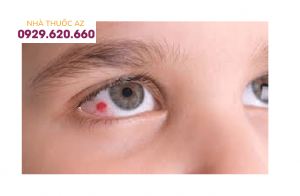 Gân máu ở mắt là bệnh gì? Nguyên nhân và và phương pháp điêu trị