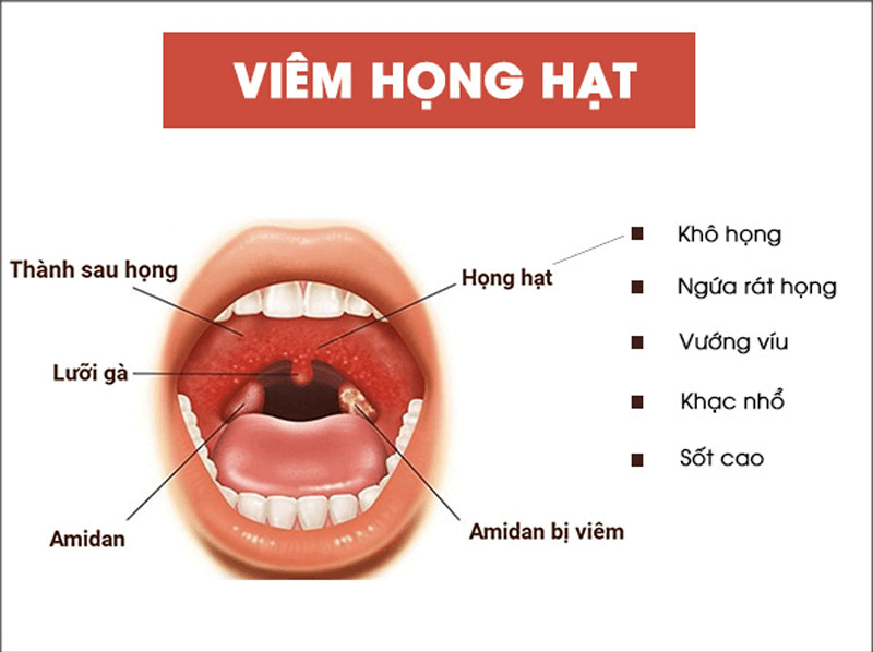 Viêm họng hạt: Dấu hiệu nhận biết và cách điều trị