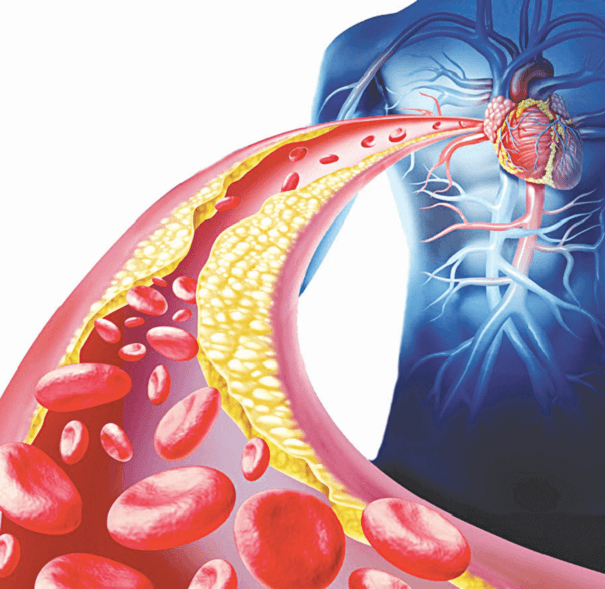 Mỡ máu cao: Nguyên nhân và những điều bạn cần biết