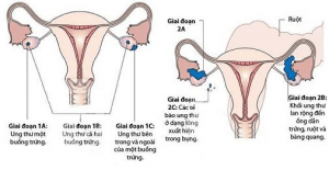 Các giai đoạn của ung thư buồng trứng