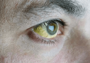 Hiện tượng tròng trắng mắt bị vàng là bệnh gì?