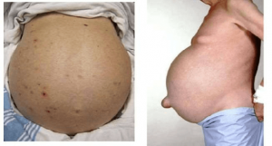 Tràn dịch ổ bụng: Dấu hiệu nhận biết và cách điều trị