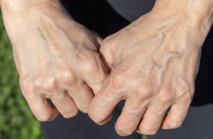 Nổi gân tay sau sinh: Nguyên nhân và cách điều trị