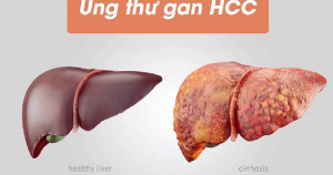 Ung thư gan HCC là gì?