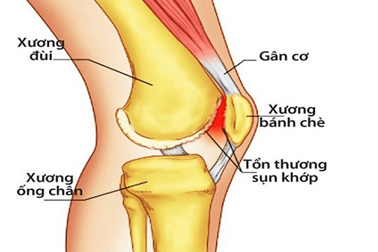 Xương bánh chè ở đâu và biến chứng gãy xương bánh chè