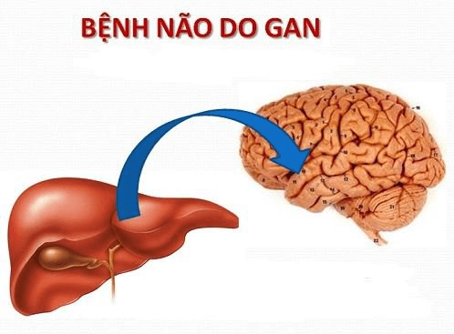 Bệnh não gan: Dấu hiệu nhận biết và cách điều trị