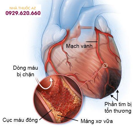 Nhồi máu cơ tim