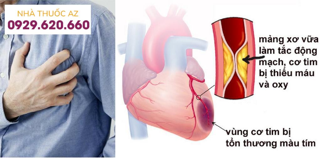 Bệnh lý động mạch vành