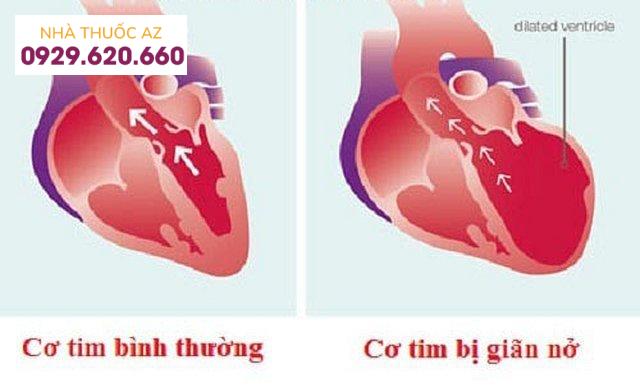 Bệnh cơ tim giãn