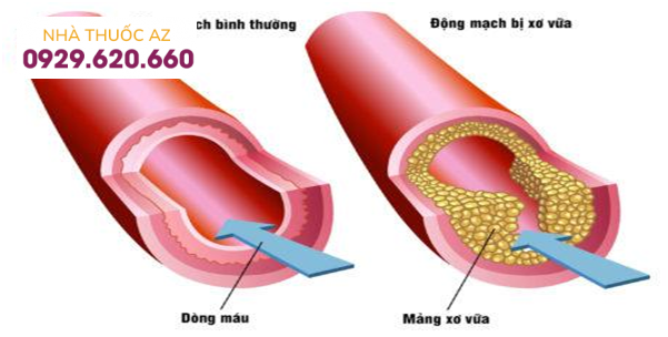 Dấu hiệu nhận biết nhồi máu cơ tim cấp