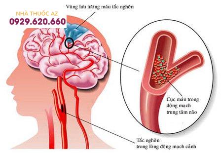 Nguyên nhân gây đột quỵ