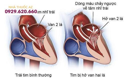 Hở van 2 lá khiến máu chảy ngược về tim
