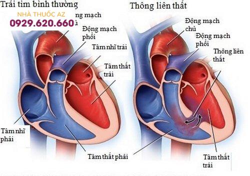 Tìm hiểu phương pháp phẫu thuật tim hở điều trị thông liên thất