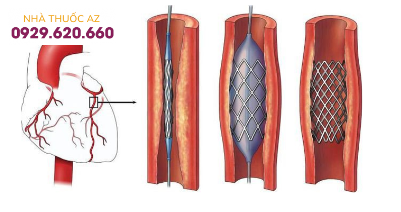 Can thiệp đặt stent mạch vành