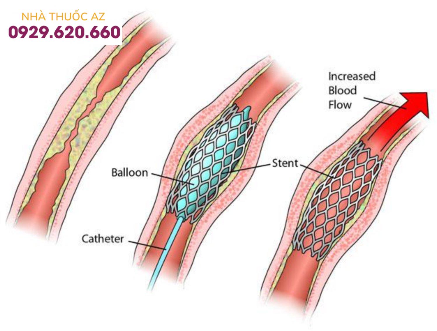 Không phải đặt stent xong là khỏi hẳn bệnh mạch vành