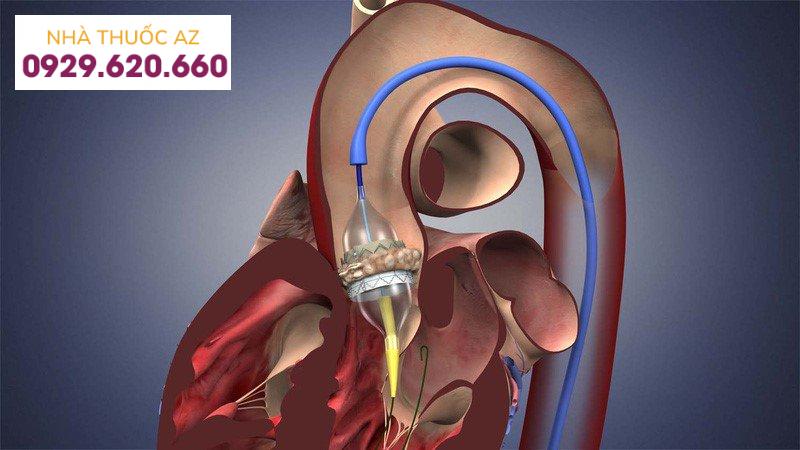 phau-thuat-kenh-nhi-that-1