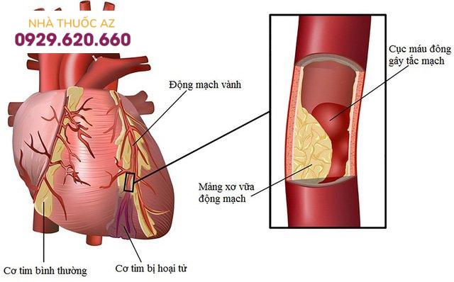 Hẹp mạch vành: Khi nào dùng thuốc, khi nào đặt stent, khi nào phải mổ?
