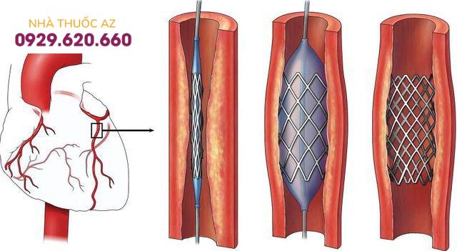 Hẹp mạch vành: Khi nào dùng thuốc, khi nào đặt stent, khi nào phải mổ?