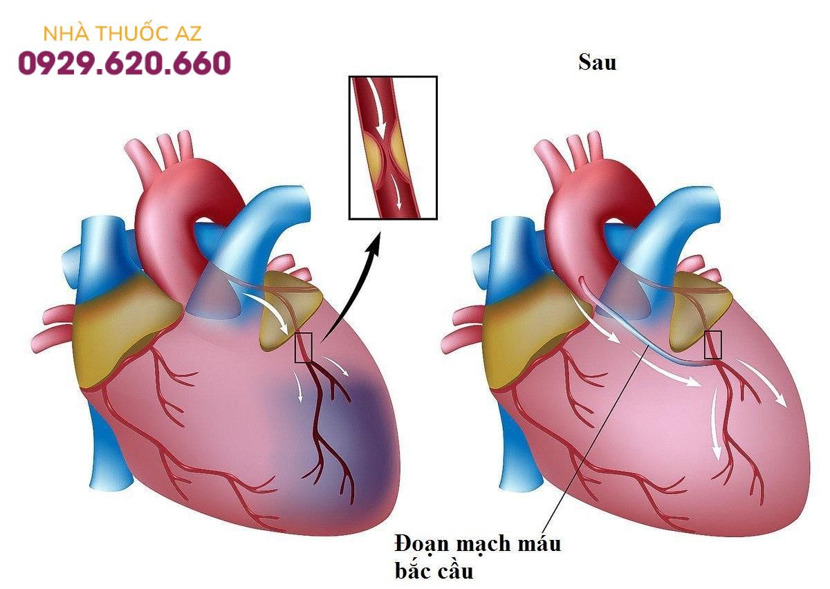 Hẹp mạch vành: Khi nào dùng thuốc, khi nào đặt stent, khi nào phải mổ?