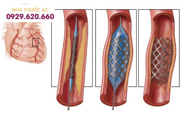 Nong mạch vành và đặt stent: Chỉ định, quy trình thực hiện, biến chứng có thể xảy ra