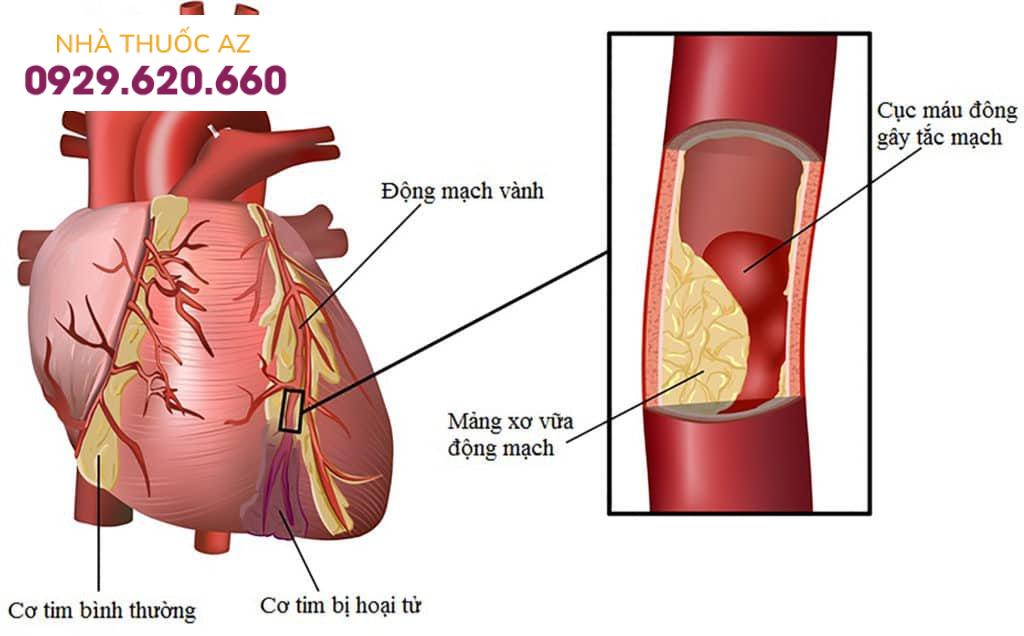Nong mạch vành và đặt stent: Chỉ định, quy trình thực hiện, biến chứng có thể xảy ra
