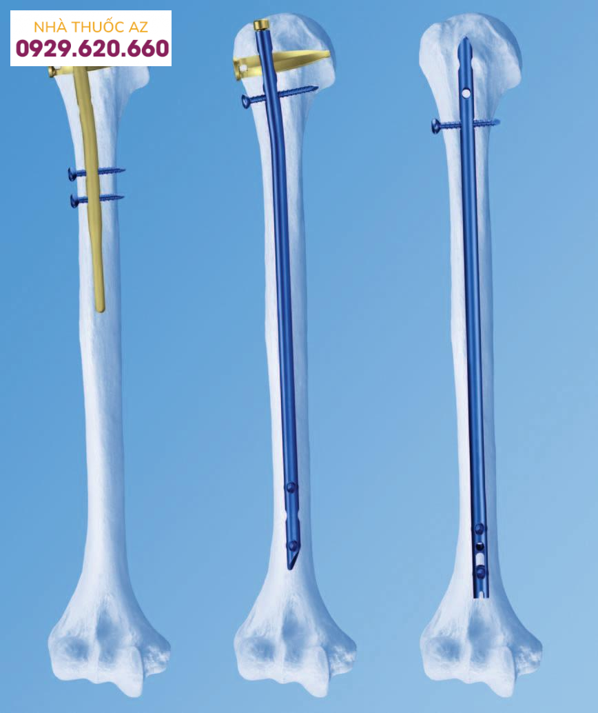 Kết hợp xương điều trị gãy xương là gì?