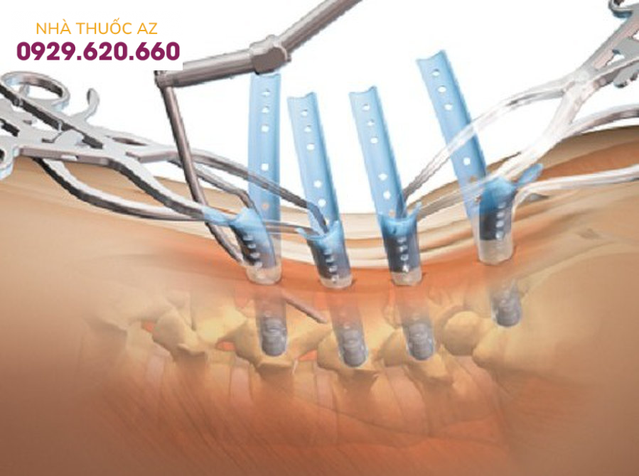 Kết hợp xương điều trị gãy xương là gì?
