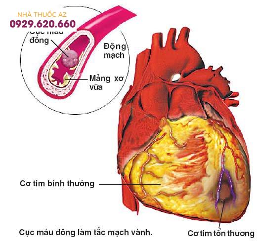 Bệnh mạch vành dẫn tới thiếu máu cơ tim