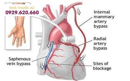 Phẫu thuật bắc cầu động mạch chủ