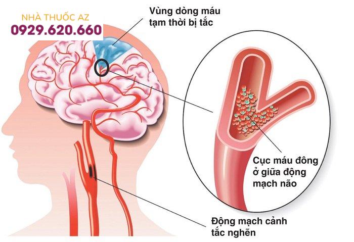 Sự hình thành cục máu đông trong tai biến mạch máu não