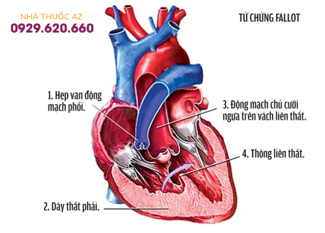 Tứ chứng Fallot