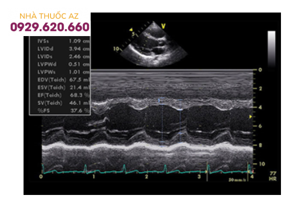 Siêu âm tim kiểu TM