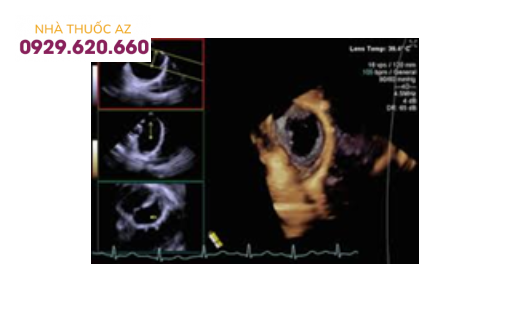 Thông liên nhĩ kích thước lớn trên siêu âm 4D