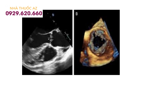 Siêu âm 4D van động mạch chủ